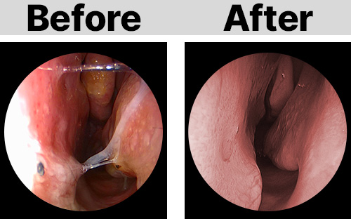 Two side-by-side images showing the throat before and after medical treatment.