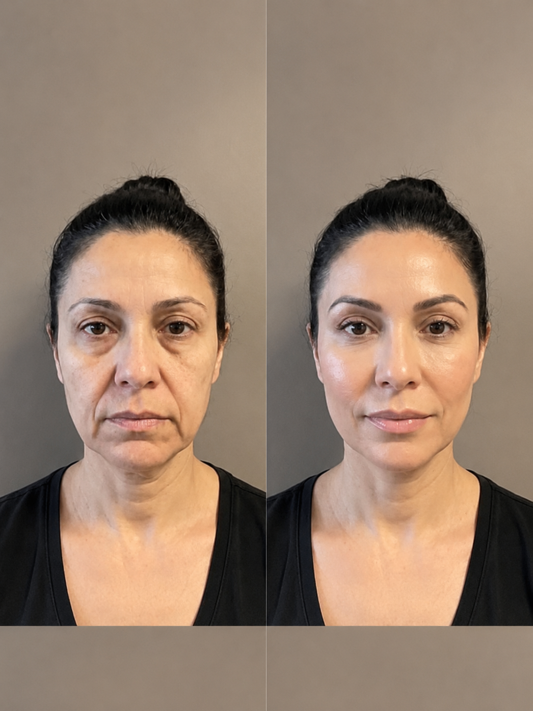 A before-and-after split image of a woman's face, showing a reduction in wrinkles and sagging skin.