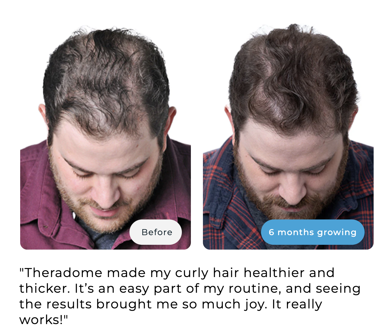 Before and after hair growth comparison of a man over six months.