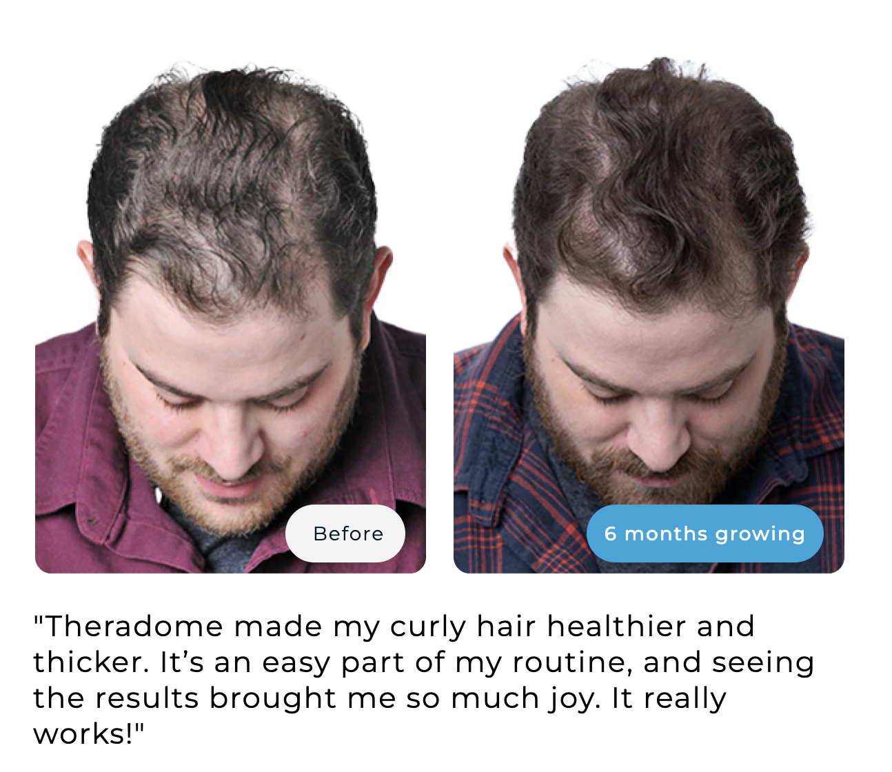 Before and after hair growth comparison of a man looking down.