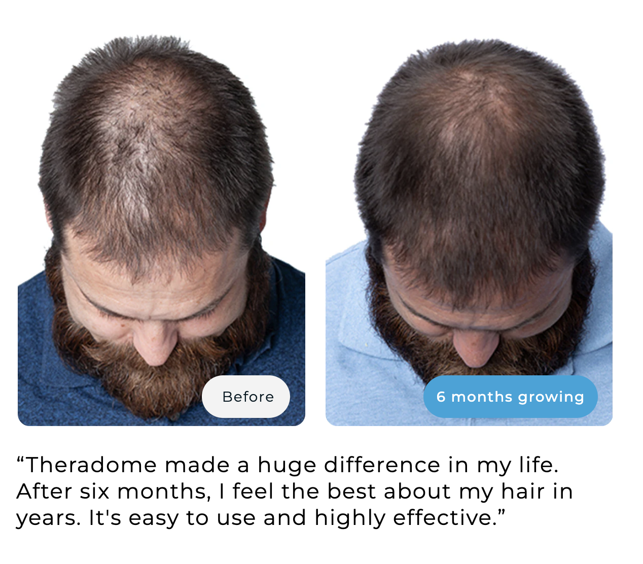 Before and after images of a man's hair growth over six months.