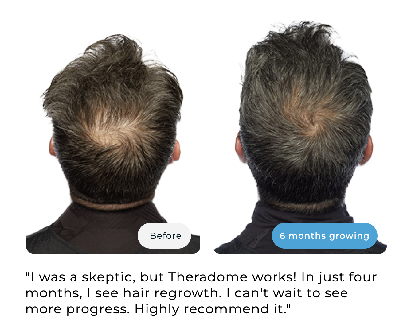 Comparison of hair growth on a man's head before and after six months.