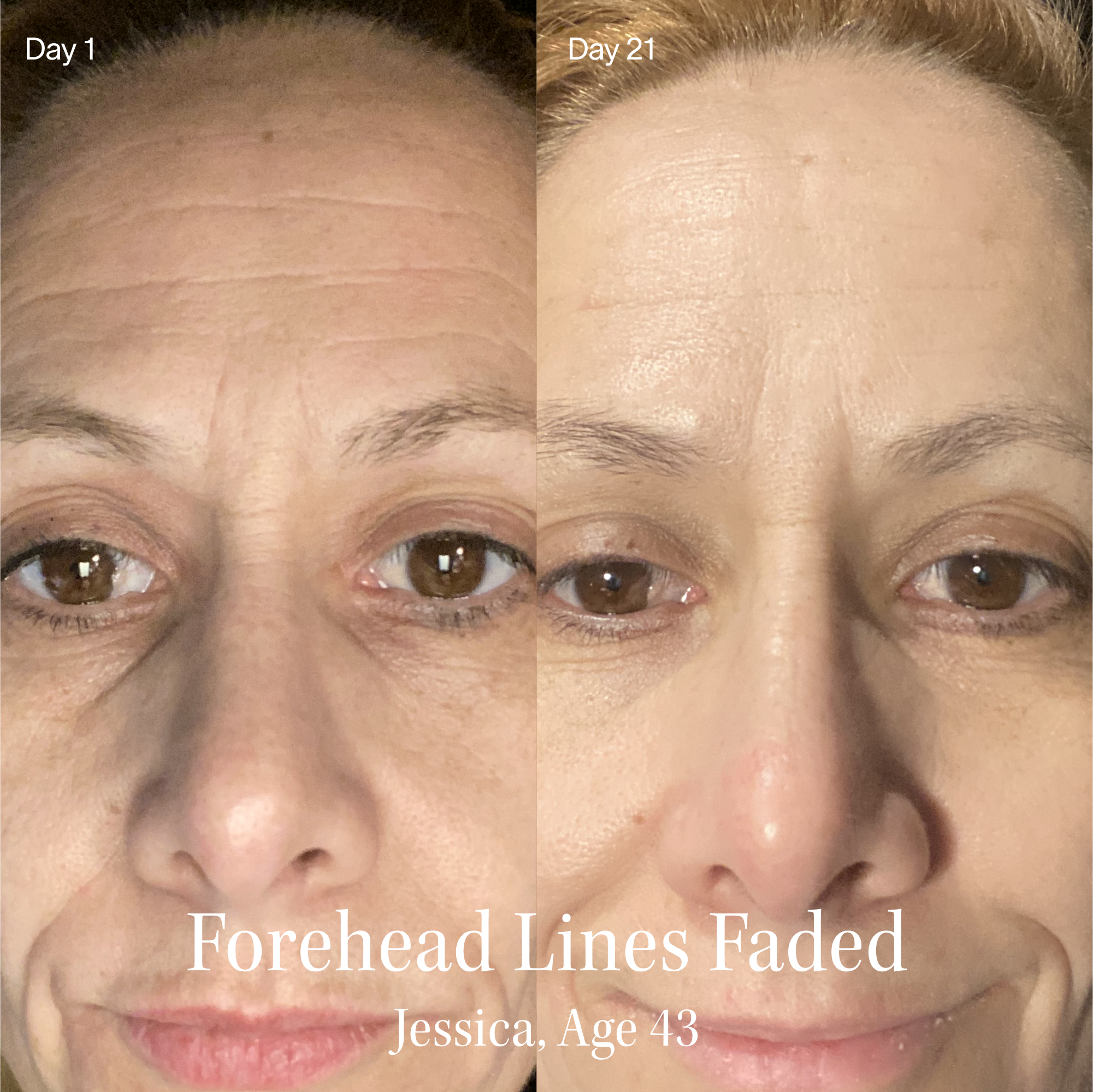 Side-by-side comparison of a woman's forehead on Day 1 and Day 21.