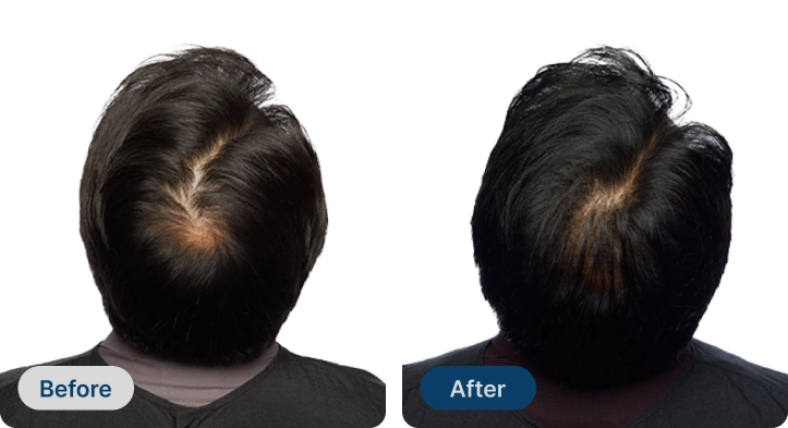 Two images comparing hair coverage labeled 'Before' and 'After'.