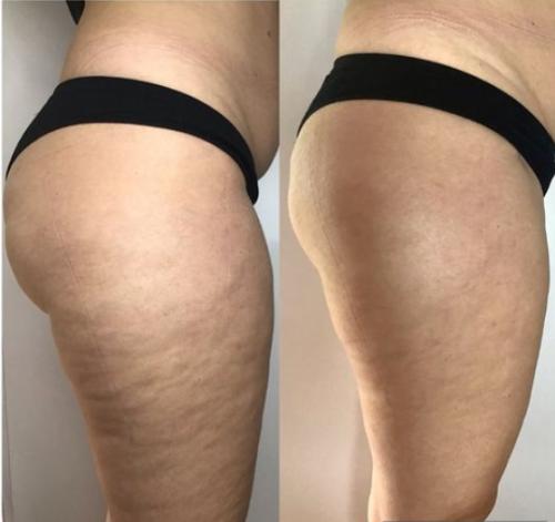 Side-by-side comparison of a person's thigh with and without cellulite.