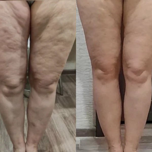 Side-by-side comparison of legs with and without cellulite.