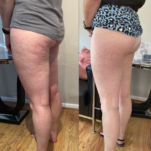 Before and after comparison of a person's legs and buttocks.