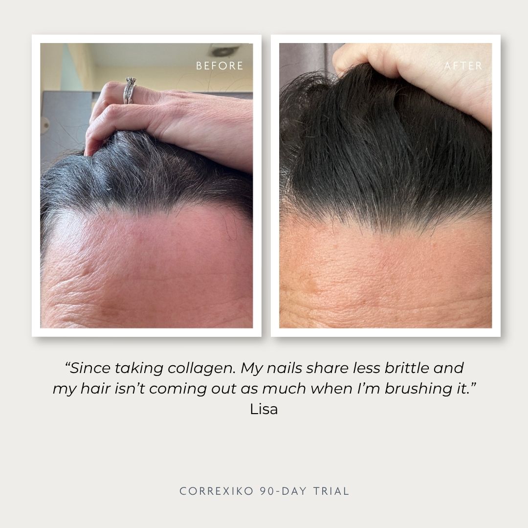 Before and after photos of a person's hairline improvement.