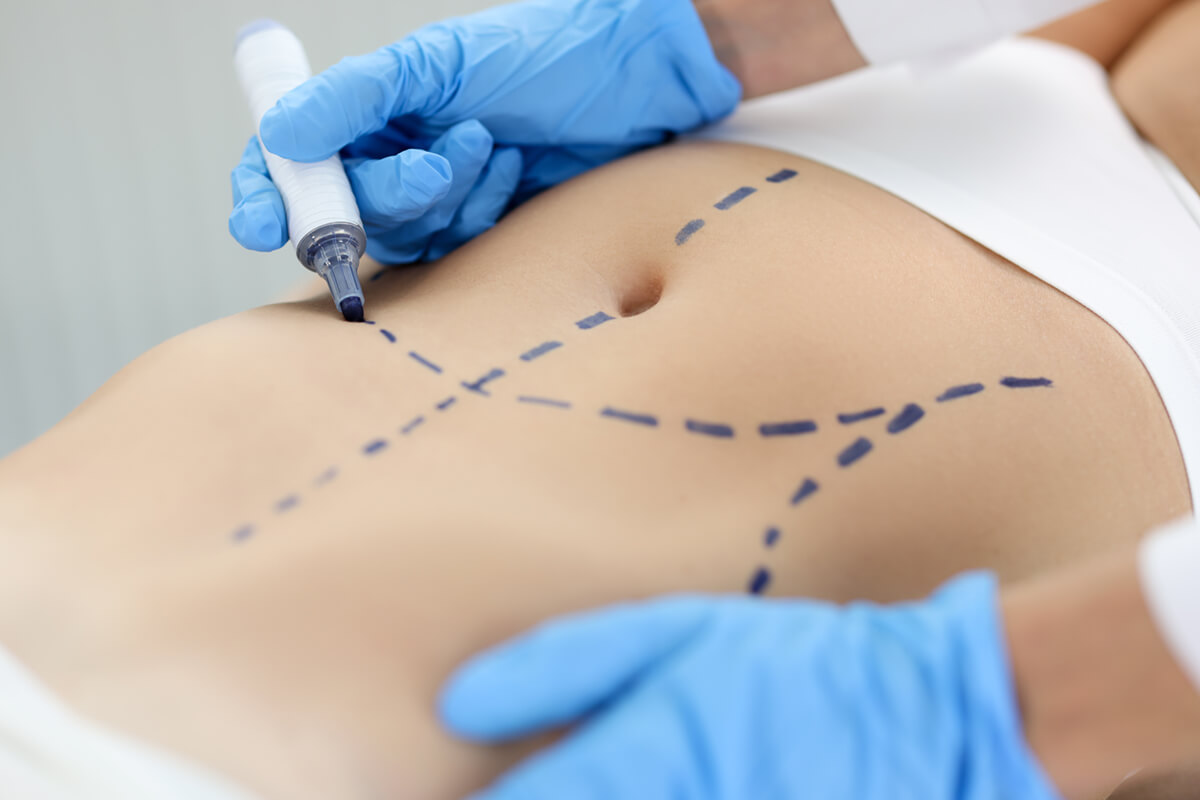 A surgeon in blue gloves draws dotted lines with a marker on a patient's abdomen before surgery.
