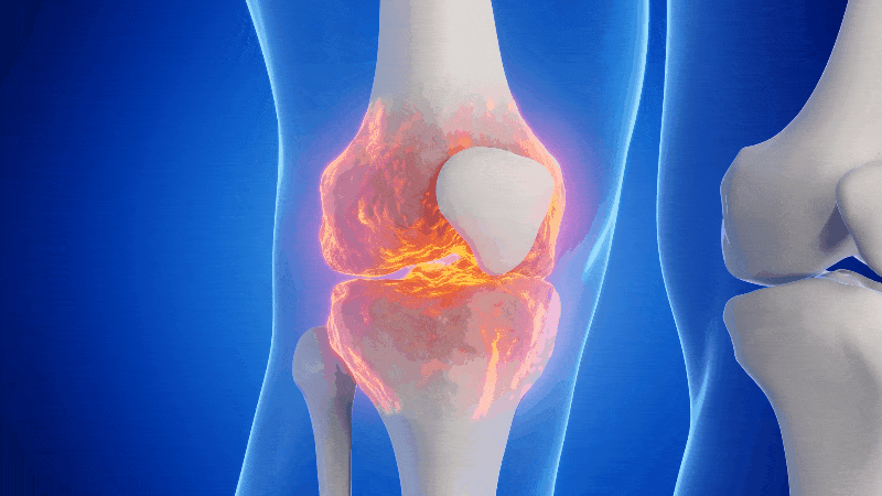 Illustration of an inflamed human knee joint with highlighted red and yellow areas.
