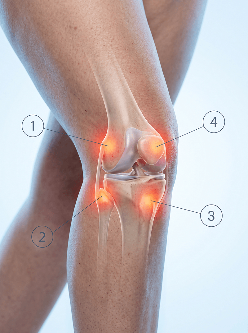 Four anatomical illustrations of the human knee, showing bones, muscles, ligaments, and nerves, with areas of inflammation.