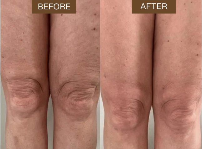 A before and after image showing the skin on a person's thighs and knees looking smoother and tighter.