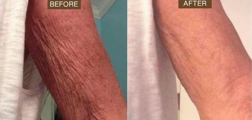 A before and after image showing an arm with wrinkled skin becoming smoother.