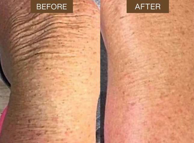 A before and after comparison of skin, showing a reduction in wrinkles and creases.