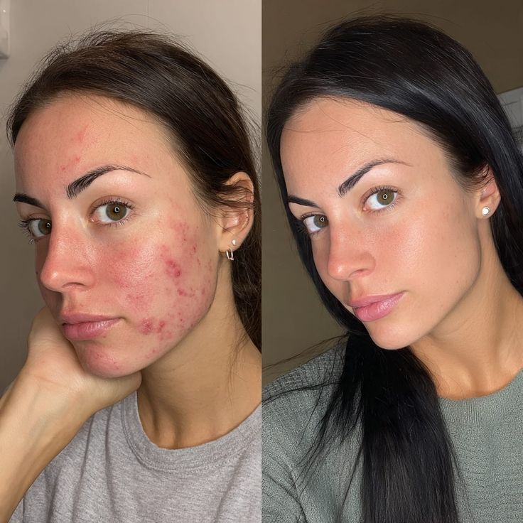 A side-by-side comparison of a woman's face, showing a reduction in acne and redness from left to right.