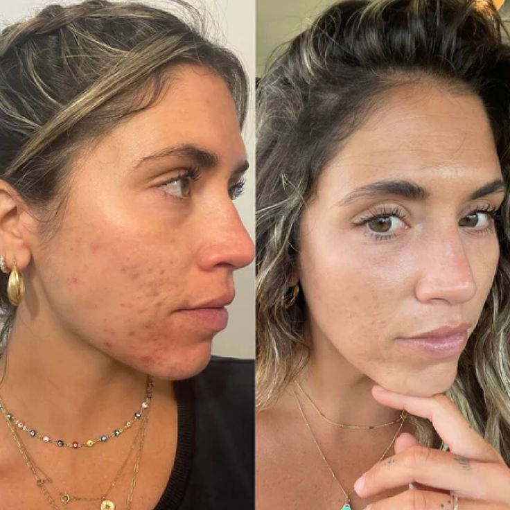 A side-by-side before and after image of a woman's face, showing a reduction in acne.