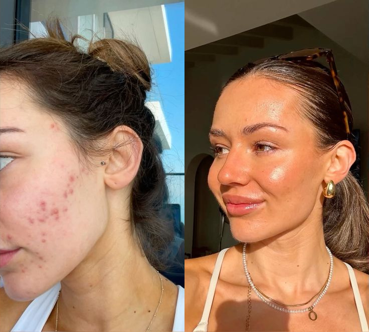 A side-by-side comparison shows a woman's face before and after her acne has cleared up.