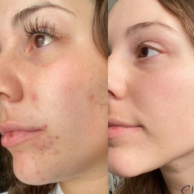 A before and after image showing a woman's face with a reduction in acne and blemishes.