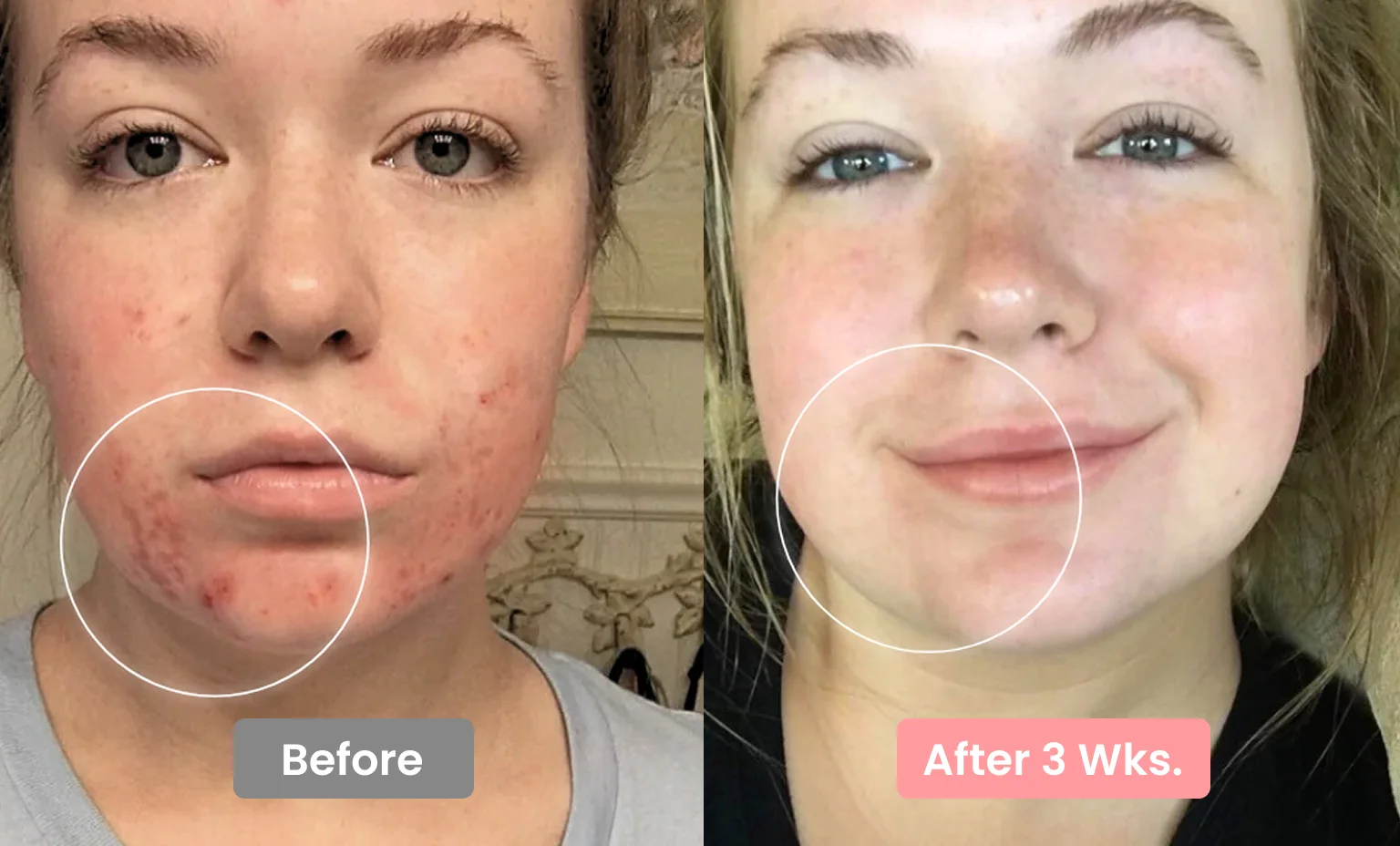 A before and after comparison showing a woman's facial acne clearing up after three weeks.