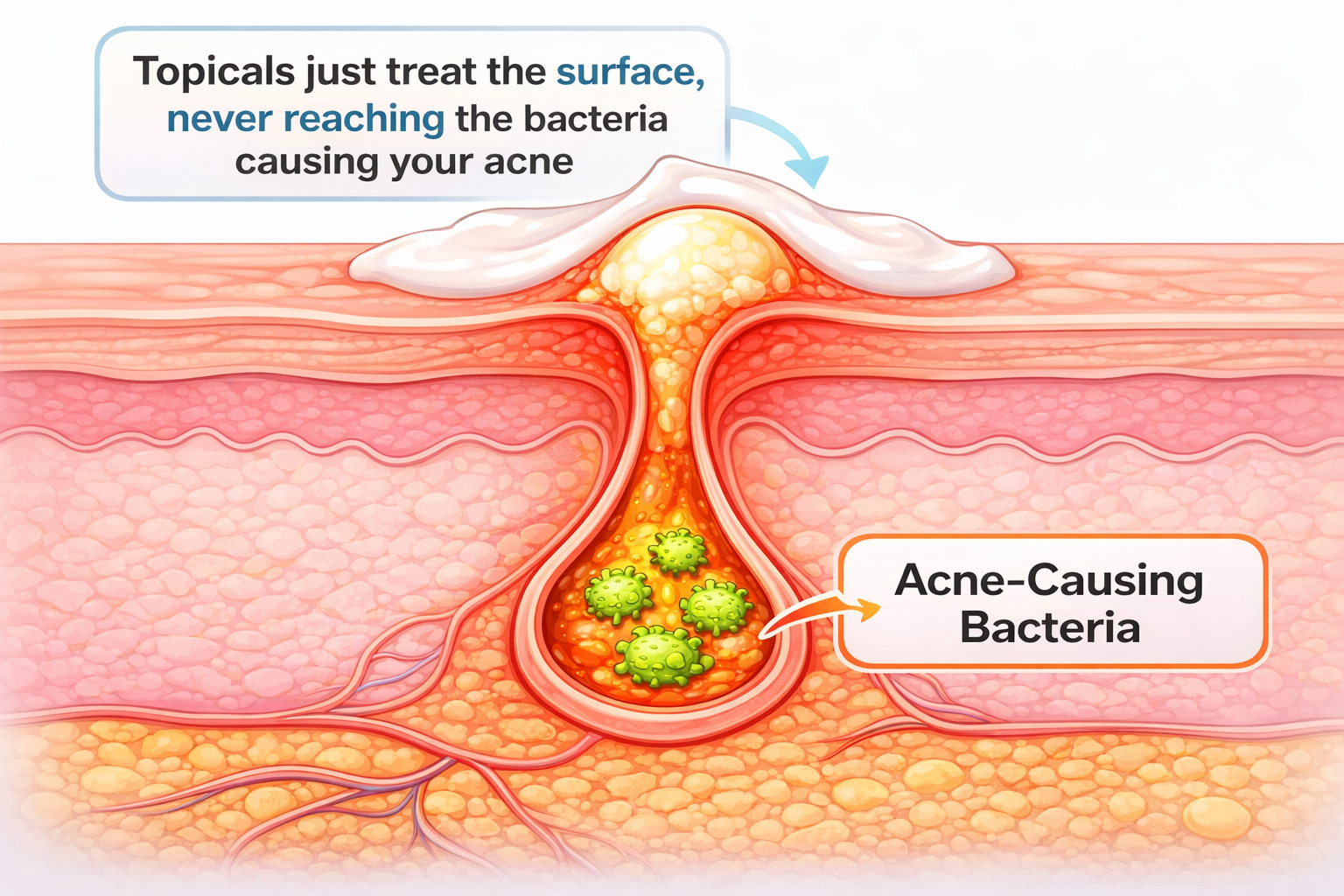 An illustration showing a cross-section of a pimple, with topical cream unable to reach bacteria deep inside.