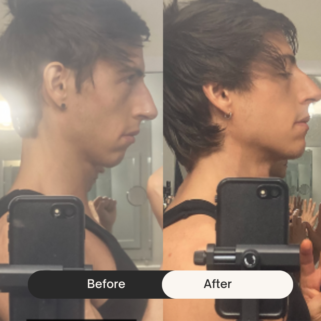Side profile comparison of a person labeled 'Before' and 'After'.
