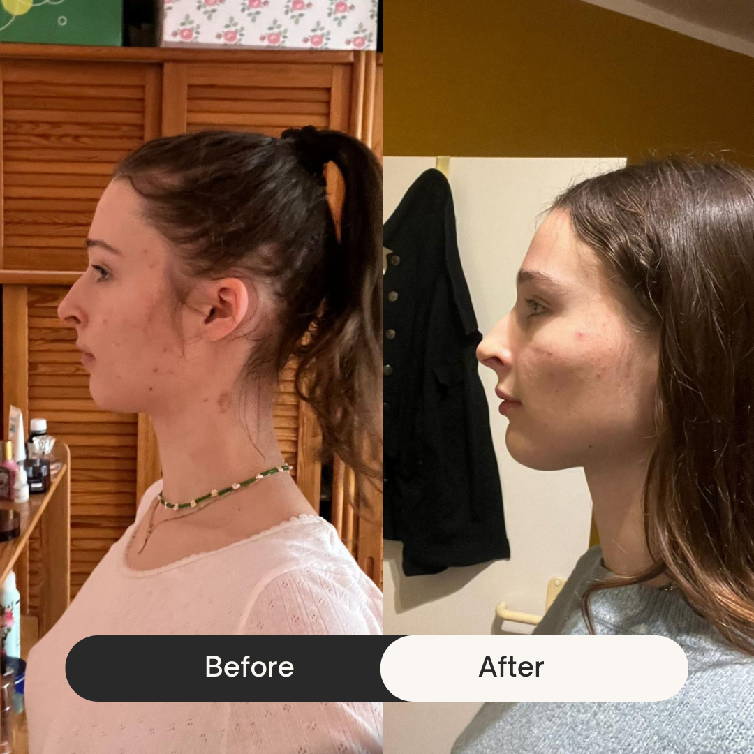 Side-by-side profile comparison of a woman labeled 'Before' and 'After.'
