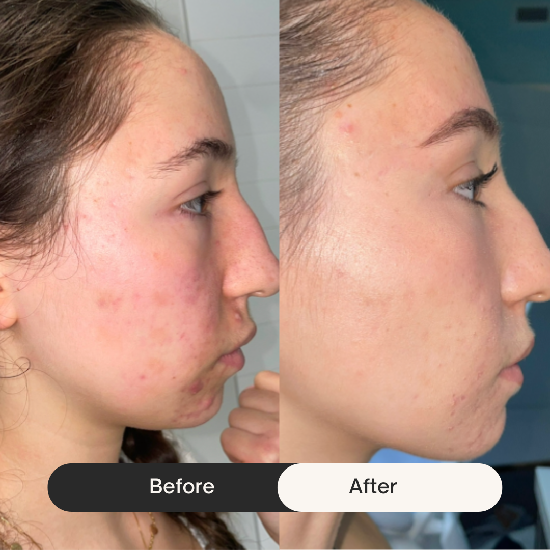 Side-by-side comparison of a person's skin before and after treatment.