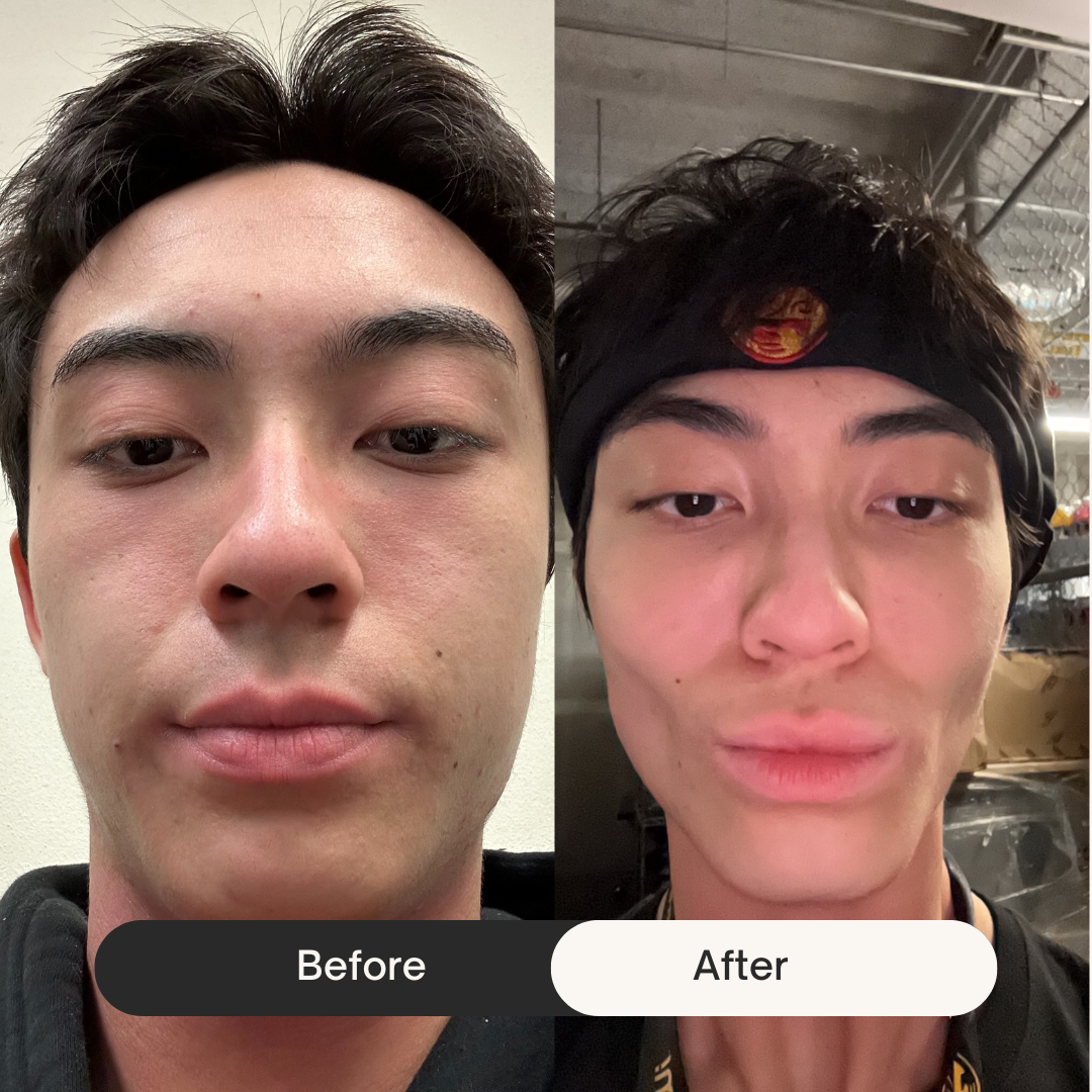 Side-by-side before and after photos of a person's face.