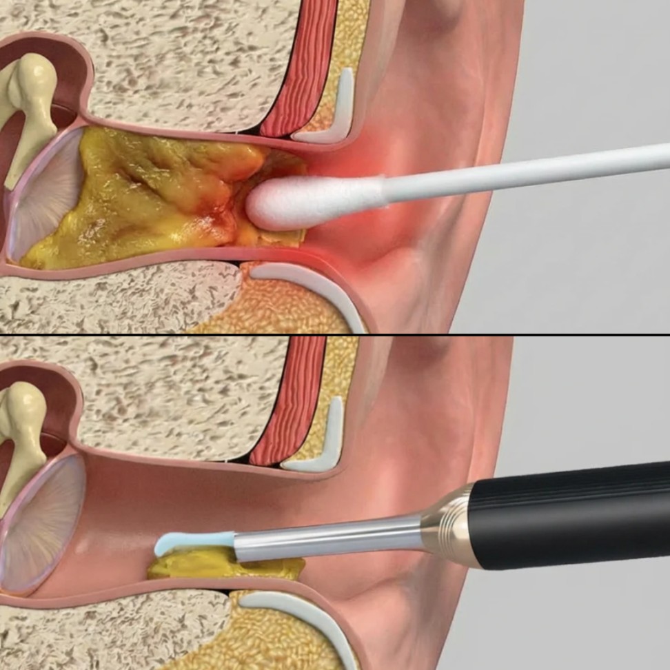 An illustration comparing a cotton swab pushing earwax deeper vs. a specialized tool safely removing it.