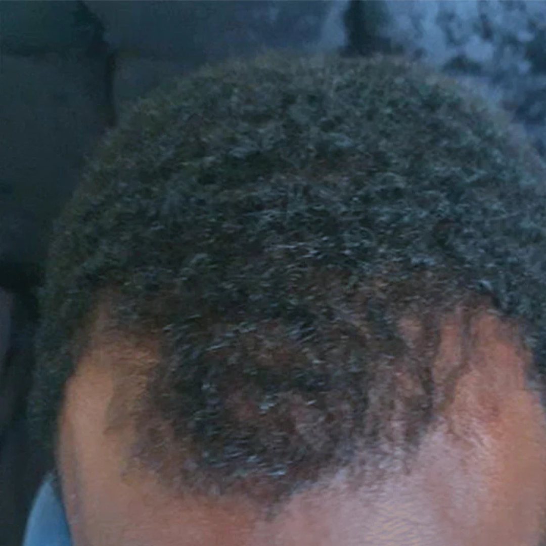 A close-up of a person's head showing short, dark, curly hair that is thinning at the hairline.