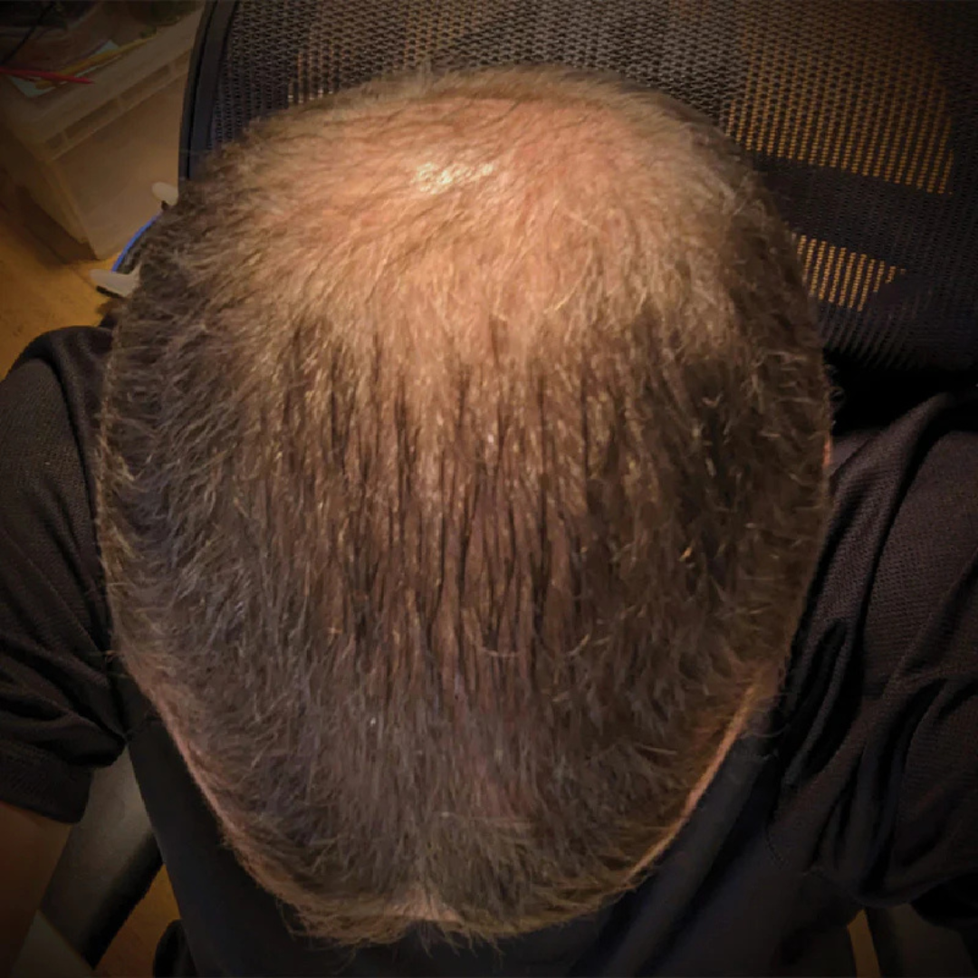 An overhead view of the top of a person's head showing thinning brown hair on the crown.