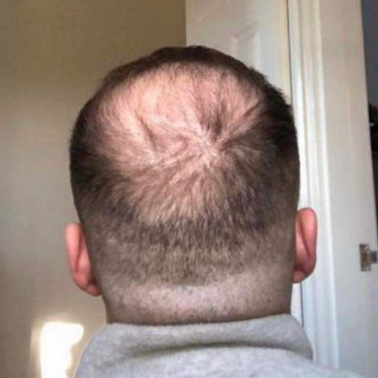 The back of a man's head showing significant hair thinning on the crown area.