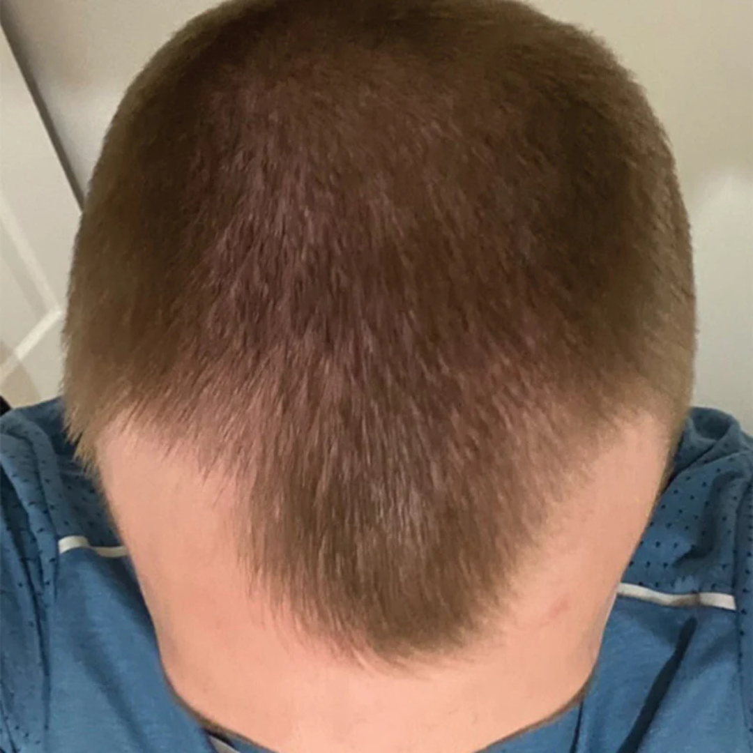 A top-down view of a person's head with short brown hair and a receding hairline.