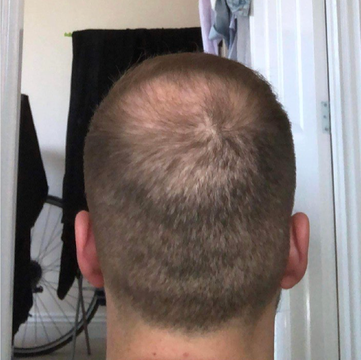 The back of a man's head with short brown hair showing thinning on the crown.