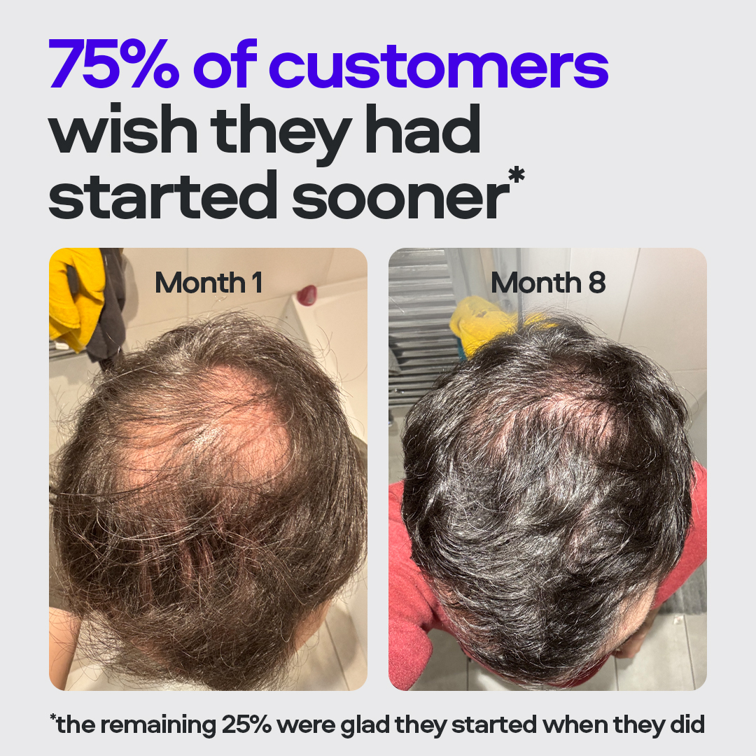 A before-and-after image showing significant hair regrowth on a man's scalp between month 1 and month 8.