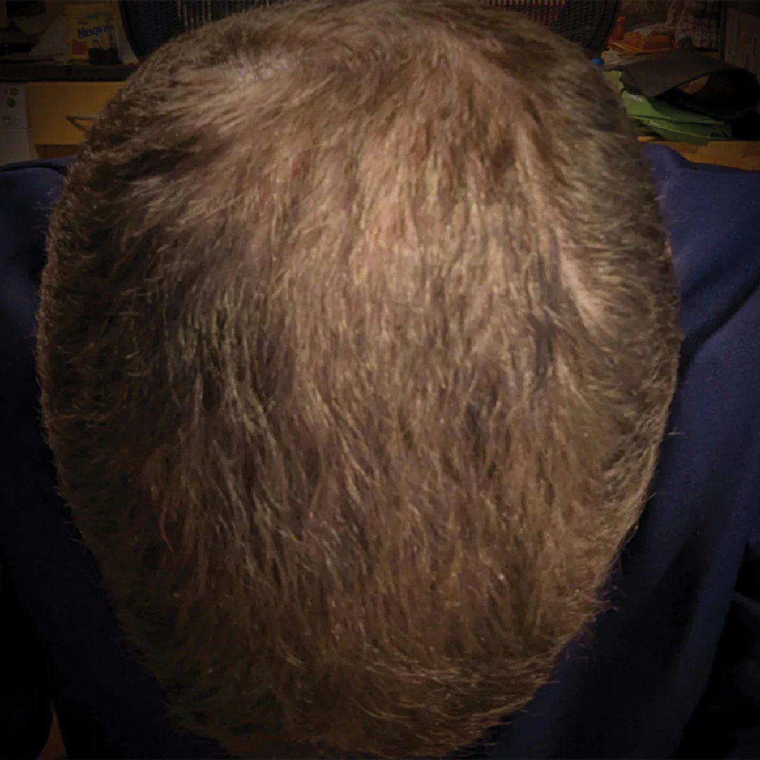 A top-down, close-up view of the crown of a person's head with short, light brown hair.