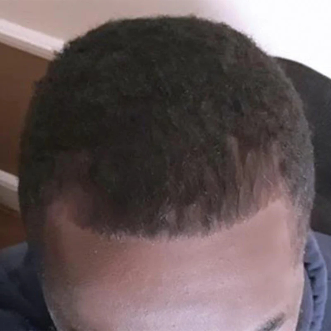 A close-up of a person's scalp with short, dark, curly hair and a defined hairline.