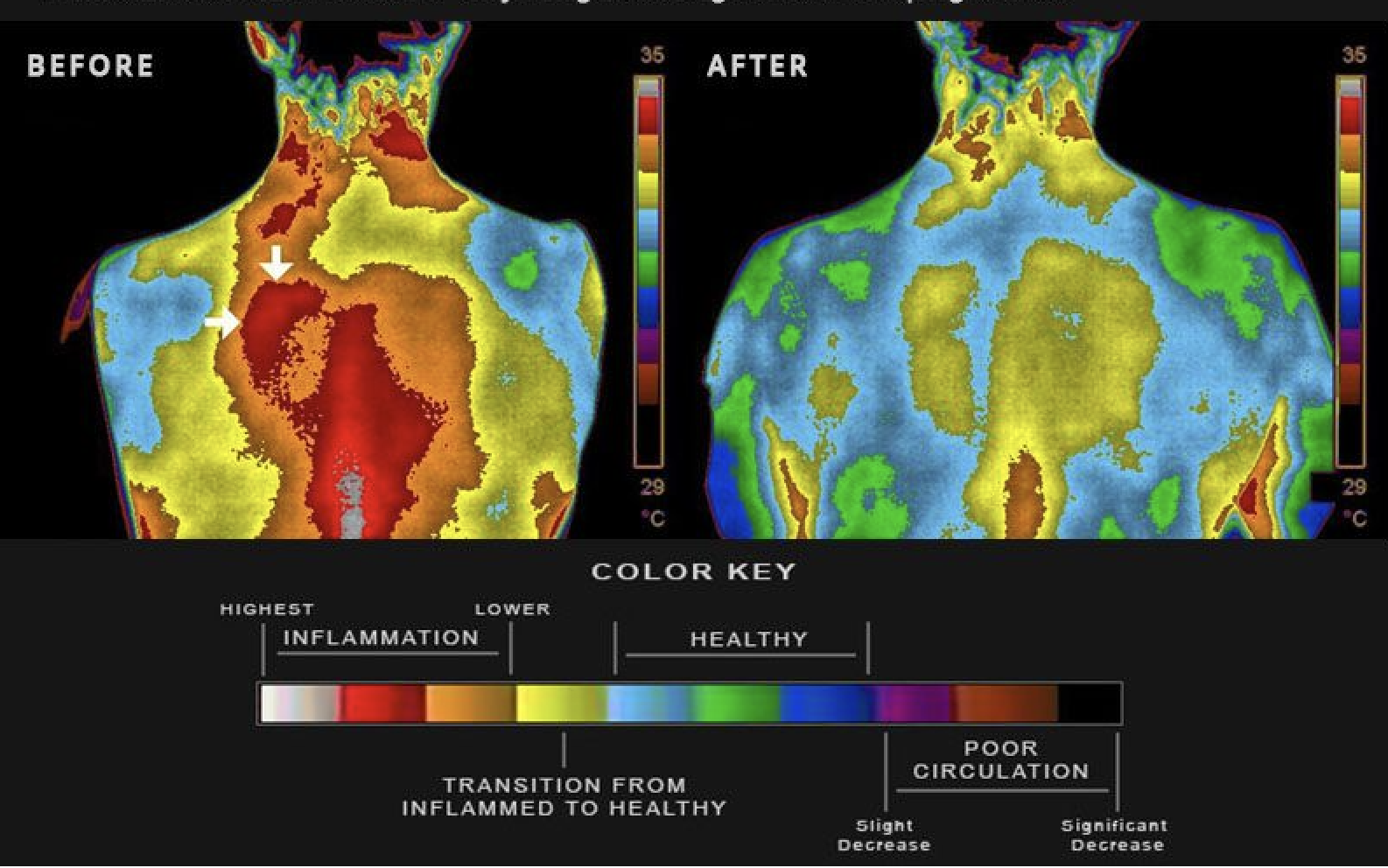 Before and after thermal scans of an upper back showing a decrease in heat and inflammation.