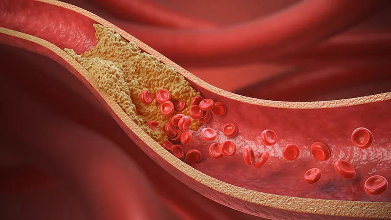 A medical illustration showing plaque buildup and red blood cells inside an artery.