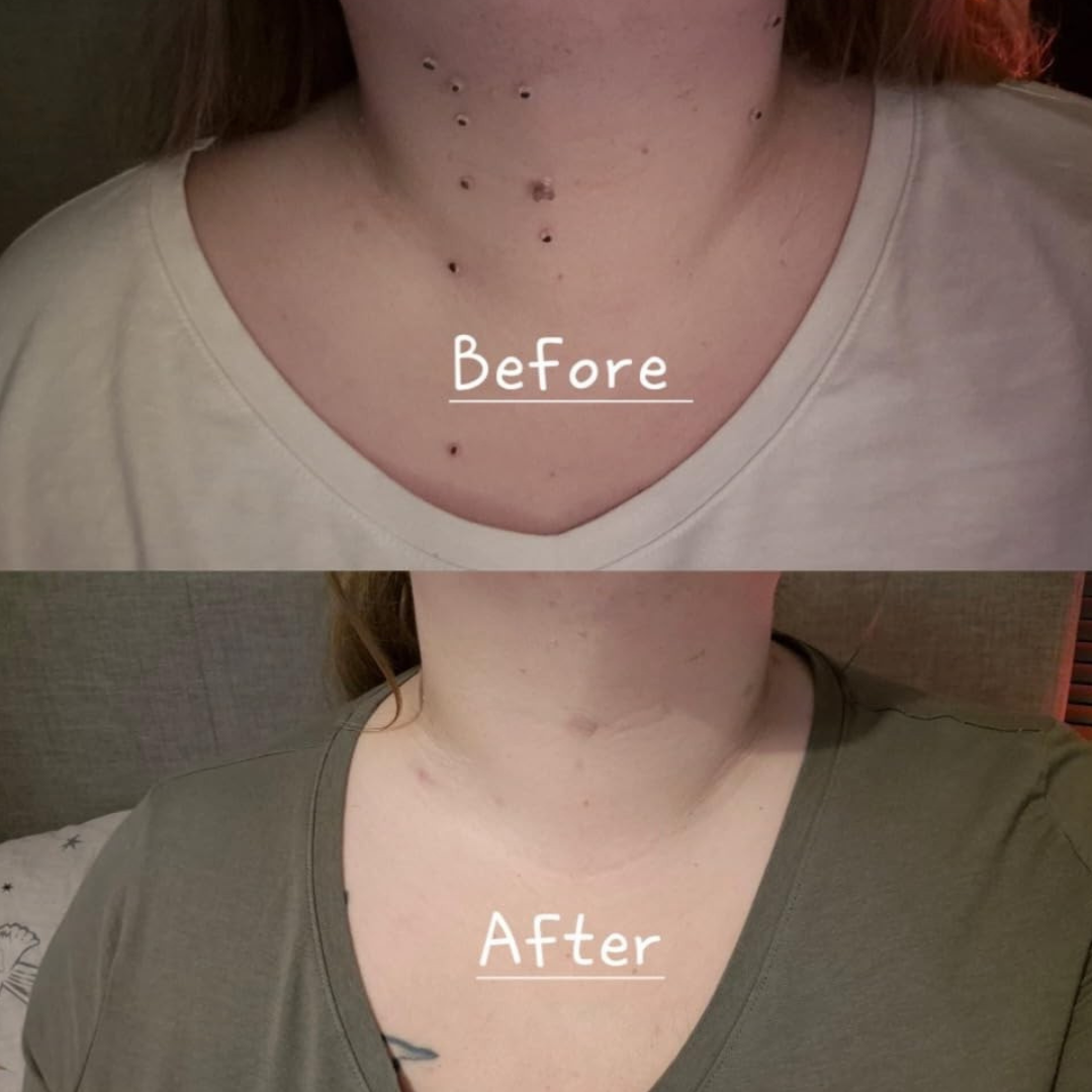 Before and after images of a neck with skin changes.