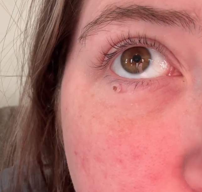 Close-up of a person's eye with a small mole below it.