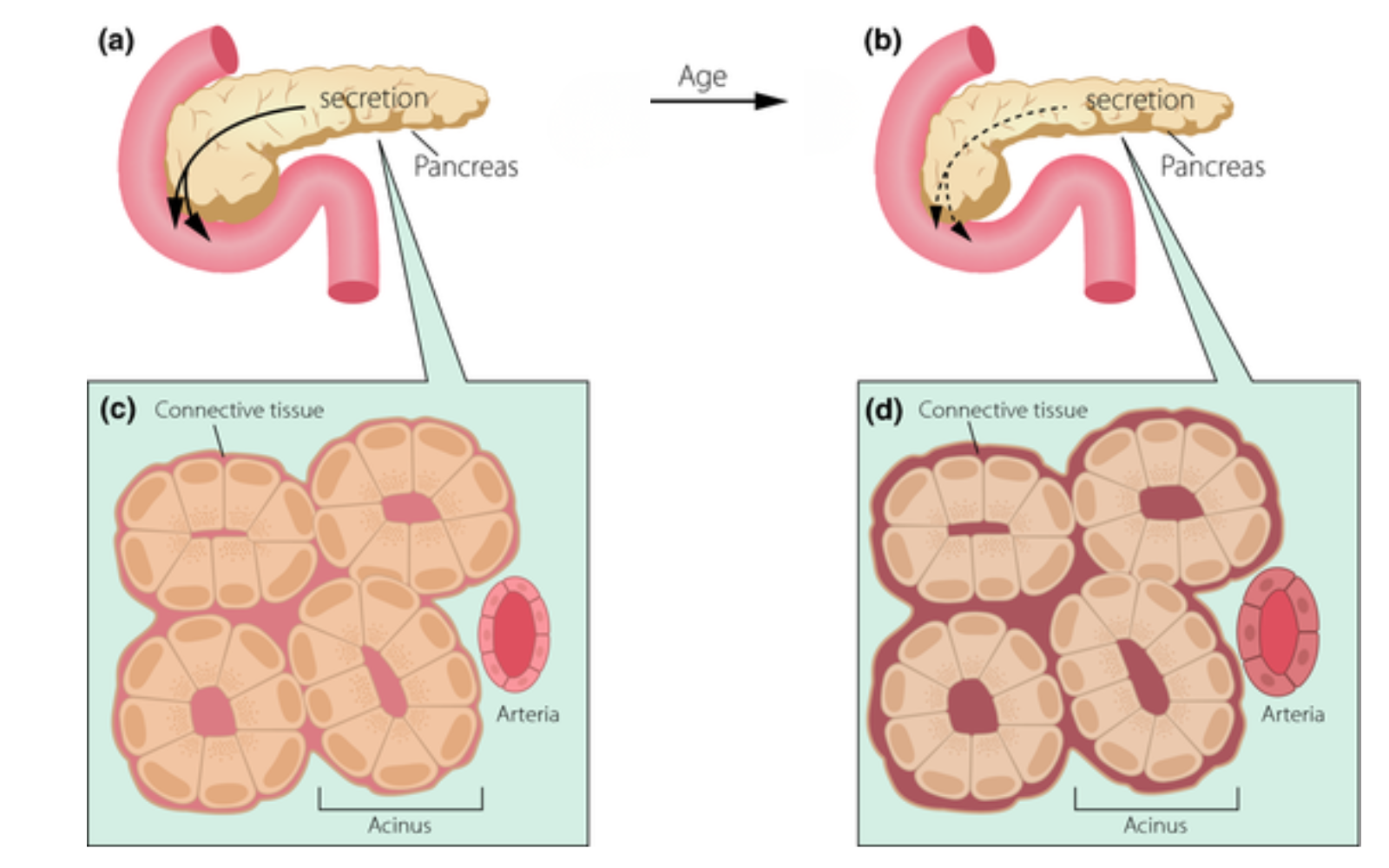 A diagram showing how age affects the pancreas, reducing secretion and increasing connective tissue at a cellular level.