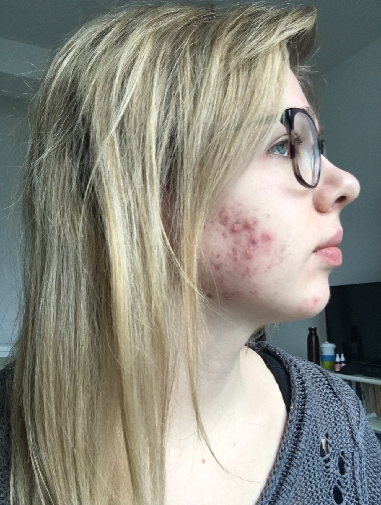 Person with glasses showing facial skin blemishes.