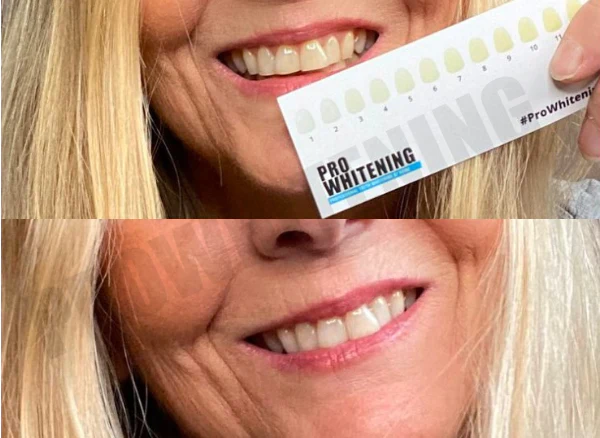 Before and after teeth whitening comparison with shade guide.