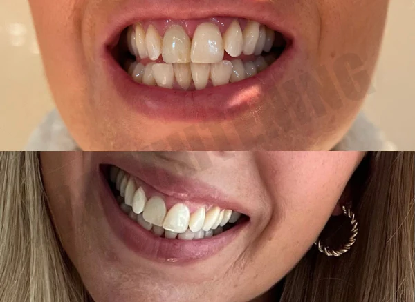 Two close-up images of smiling mouths showing teeth.