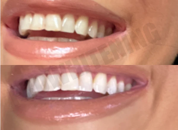 Two close-up images of a smiling mouth showing teeth.