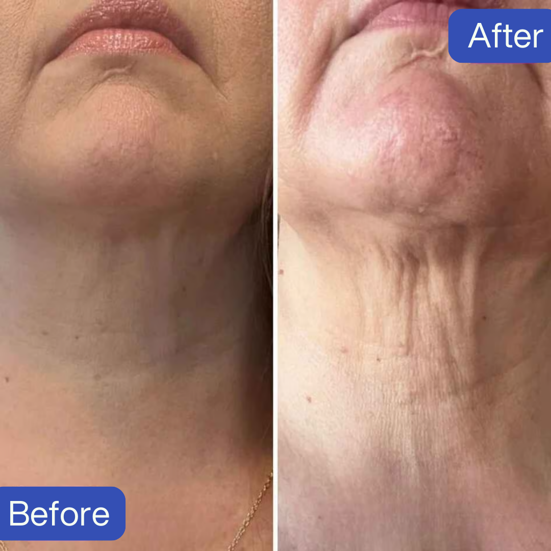 Side-by-side comparison of a neck, labeled 'Before' and 'After.'