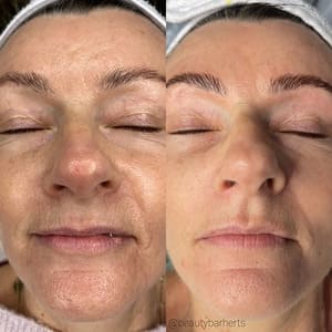 Close-up of a woman's face before and after a skincare treatment.