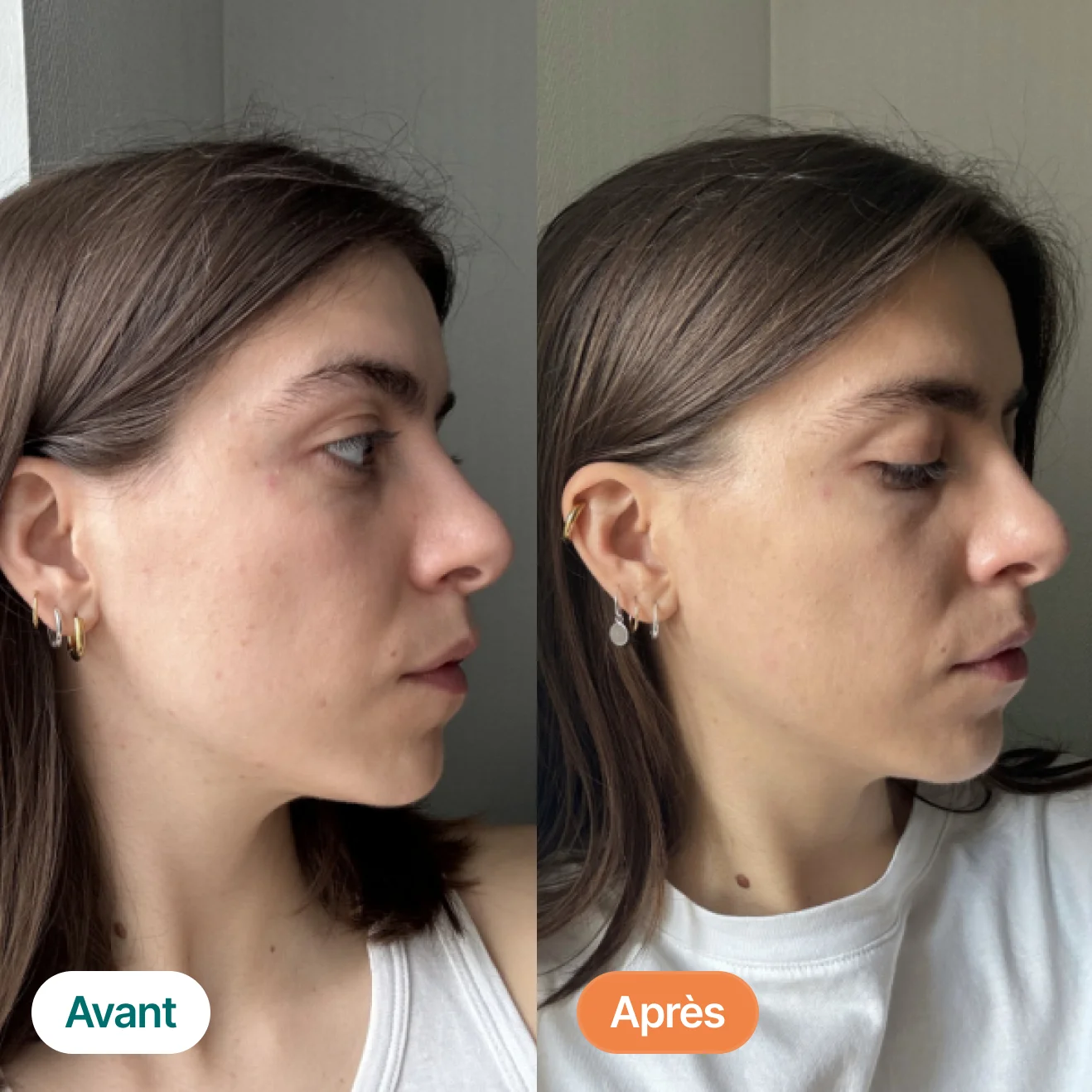 Side-by-side comparison of a woman's profile before and after.