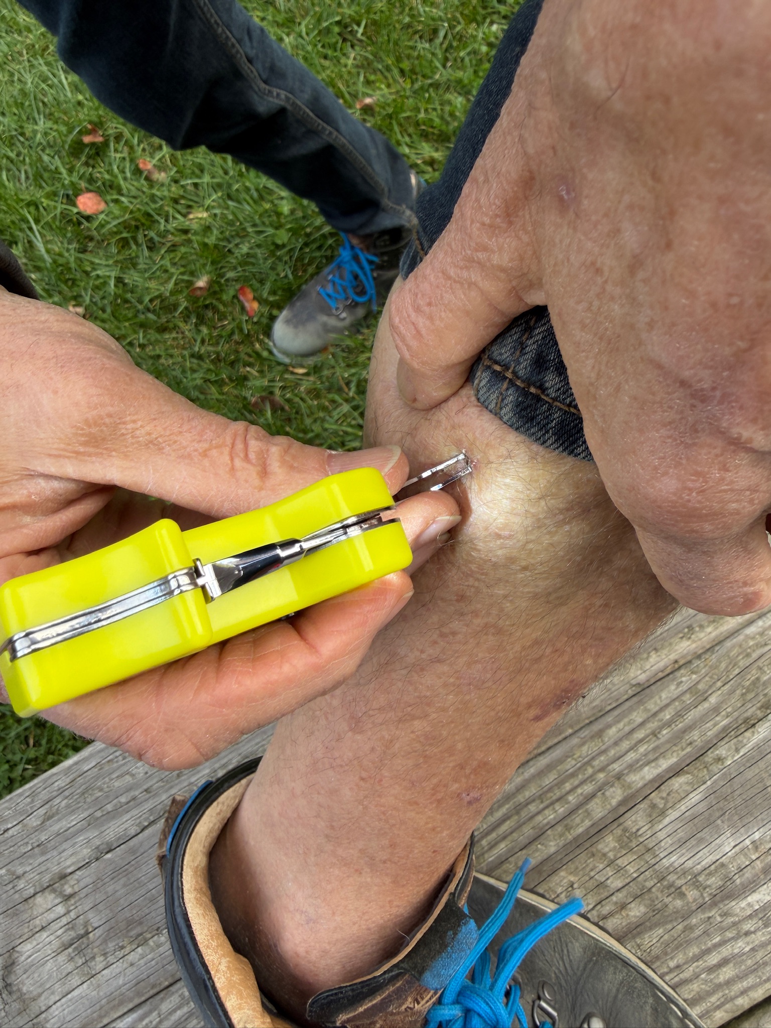 Tick removal on person